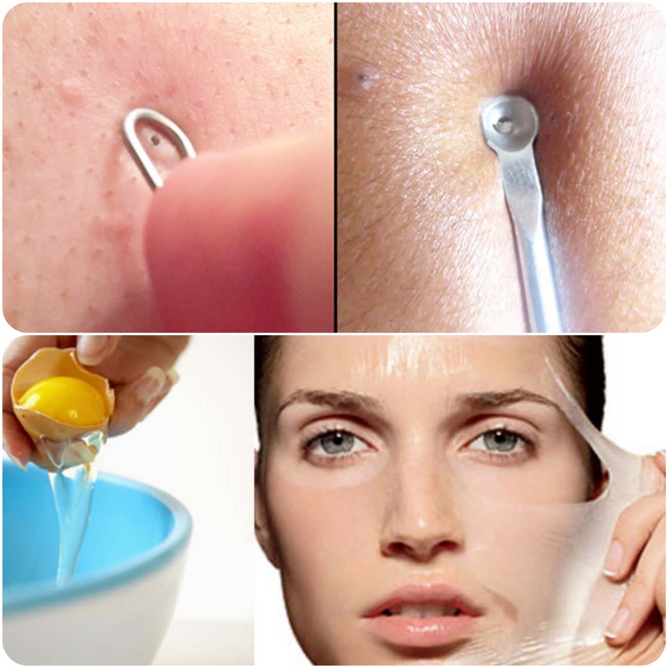 Remove Blackheads...Tips To Remove Pores On Your Skin- Top 5...styloplanet.com